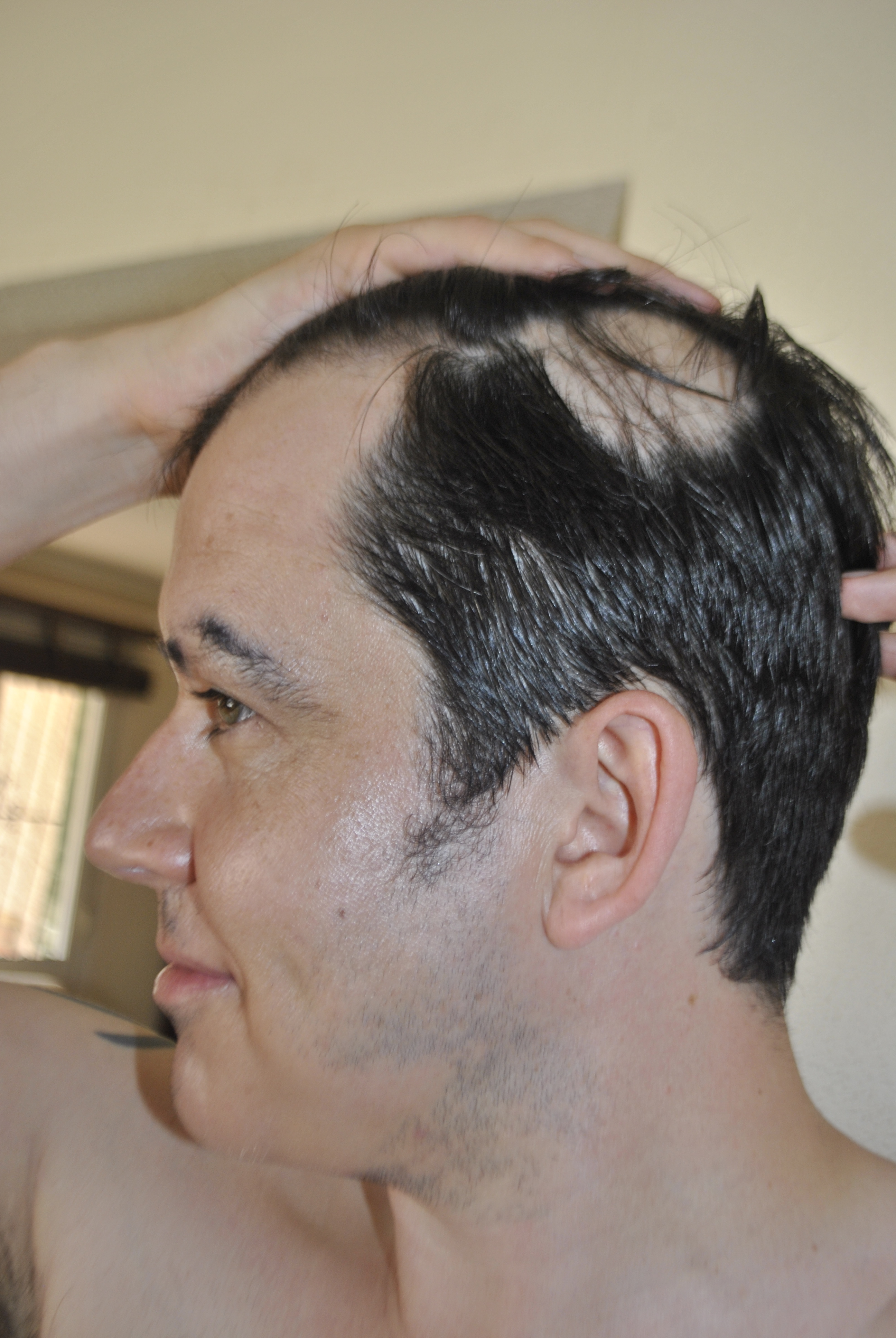 Partial loss all over