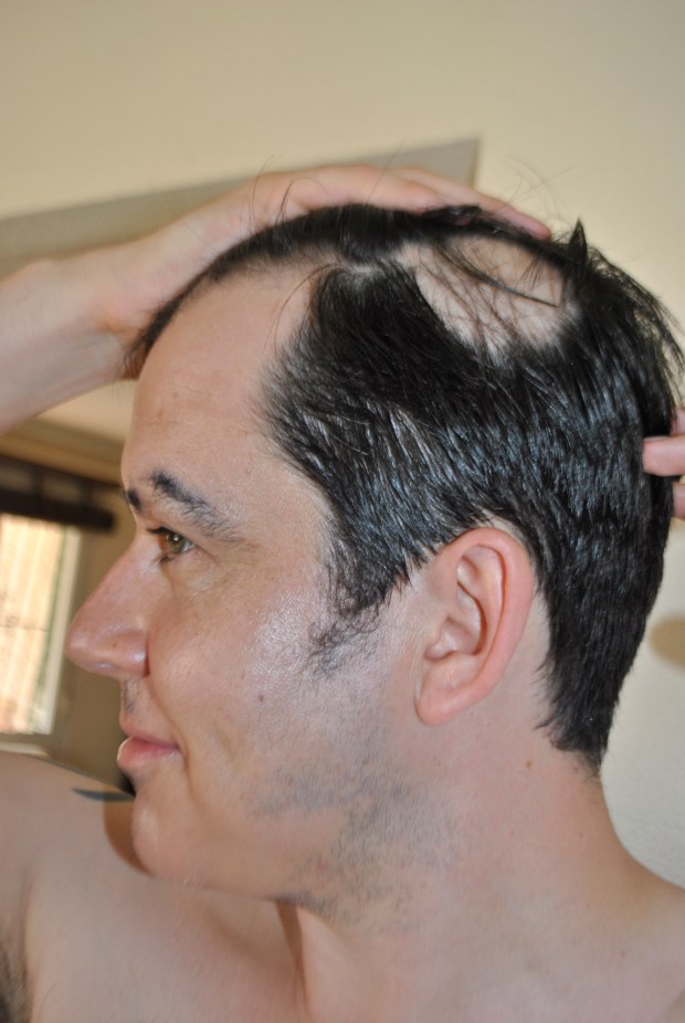 Partial loss all over