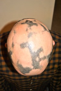 my disappearing hairline