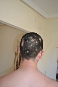 shaved head with alopecia