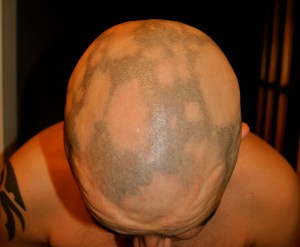 My head with alopecia