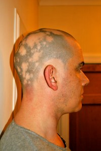 Alopecia head