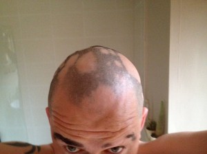 My head with alopecia