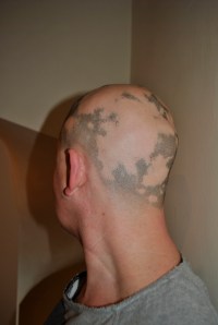Alopecia hair May 2013