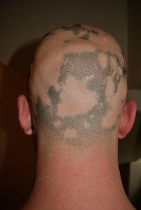 Alopecia hair May 2013