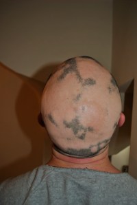 Alopecia hair May 2013