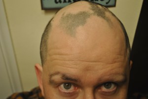 Alopecia hair February 2013