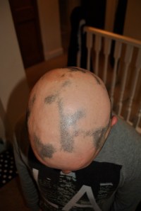 Alopecia hair May 2013