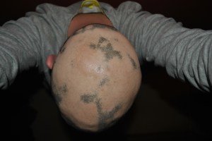 Alopecia hair July 2013