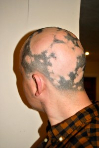 Alopecia hair February 2013