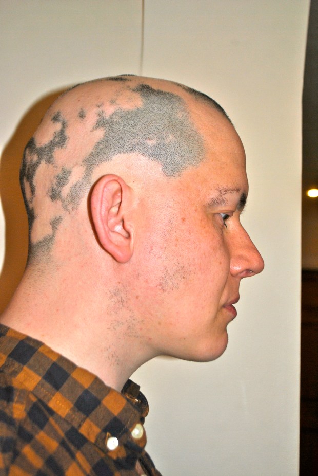 Alopecia hair February 2013