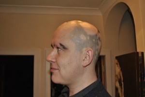 My Alopecia December 2012