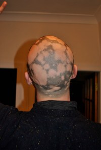 My Alopecia December 2012