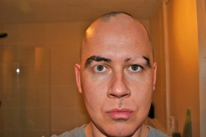 alopecia on an eyebrow