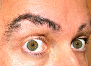 Alopecia Eyebrows and missing eyelashes