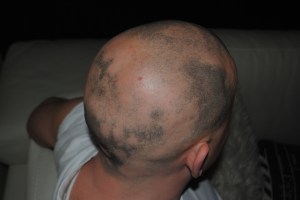 Alopecia regrowth November 2013
