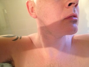 alopecia facial hair