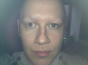 shaved eyebrows following alopecia