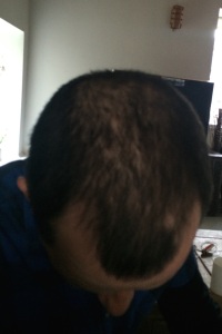 top of a head recpvering from alopecia areata