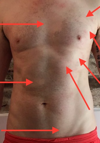 alopecia areata patches on my chest