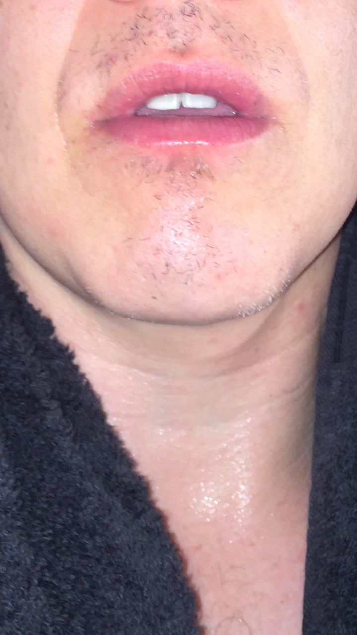 half moustache regrowth from alopecia