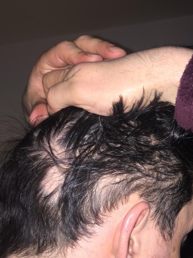 patches of alopecia
