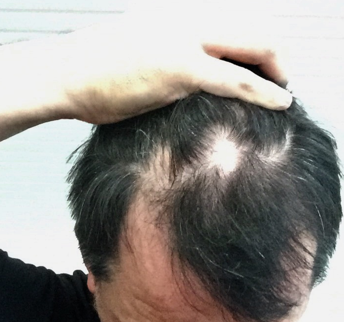 The middle patch in August 2018